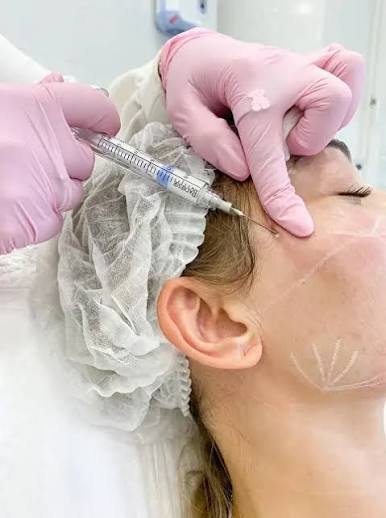 Векторний ліфтинг Корекція стрій (Aesthetic Dermal)